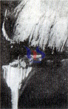 cementado desgaste de la herramienta de carburo