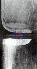 cementado desgaste de la herramienta de carburo