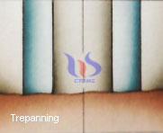 perforación tecnología trepanación